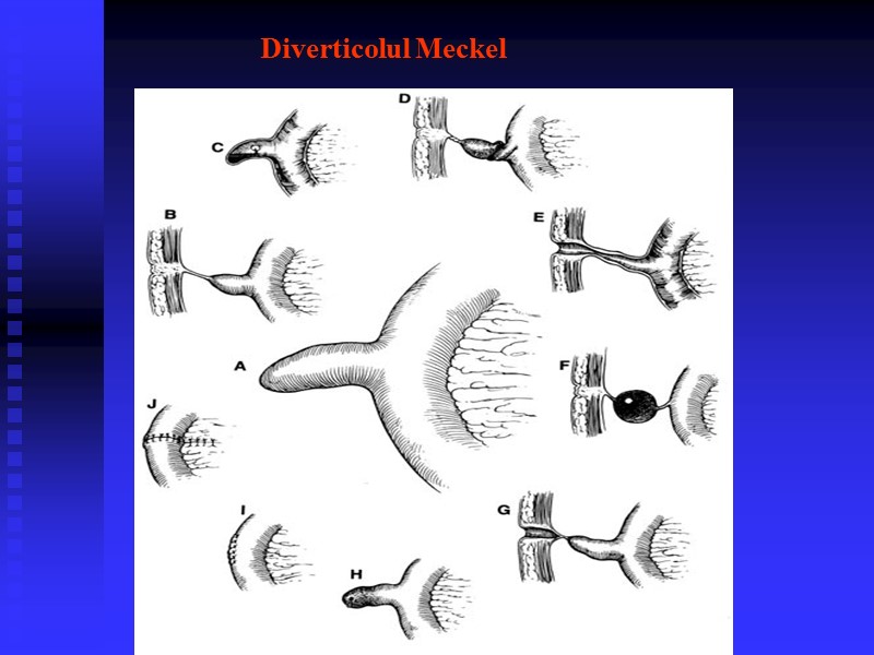 Diverticolul Meckel